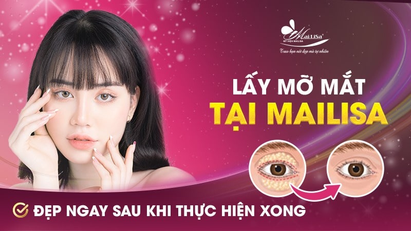 Có nên lấy mỡ mí mắt nội soi không và những điều cần tránh 12 - 12 lấy mỡ mí mắt nội soi lấy mỡ mí mắt nội soi