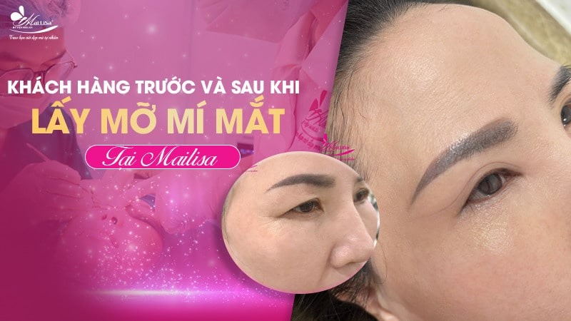 Lấy mỡ mí mắt trên bao nhiêu tiền? Dịch vụ ở đâu tốt 14 - 14 lấy mỡ mí mắt trên bao nhiêu tiền lay mo bong mat gia bao nhieu