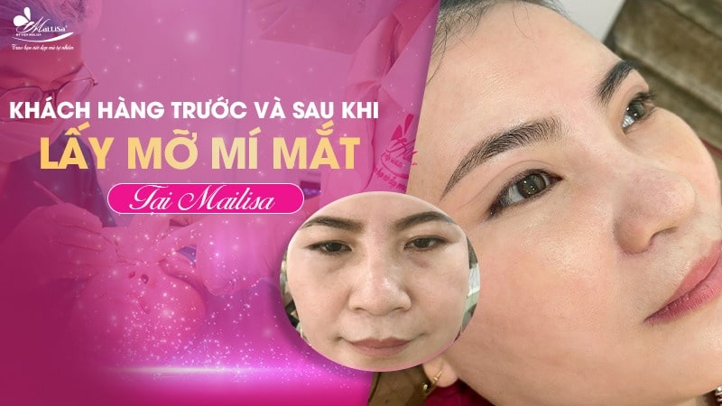 Lấy mỡ mí mắt trên bao nhiêu tiền? Dịch vụ ở đâu tốt 15 - 15 lấy mỡ mí mắt trên bao nhiêu tiền lay mo mat khong phau thuat