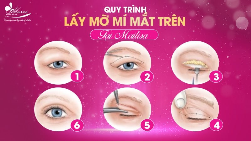 Lấy mỡ mí mắt trên bao nhiêu tiền? Dịch vụ ở đâu tốt 10 - 10 lấy mỡ mí mắt trên bao nhiêu tiền lay mo mi mat gia bao nhieu