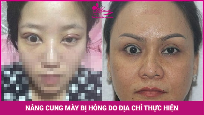 Biến chứng nghiêm trọng nâng cung mày bị hỏng 2023 Biến chứng nâng cung mày