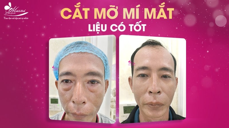 Lấy mỡ mí mắt trên bao nhiêu tiền? Dịch vụ ở đâu tốt 5 - 5 lấy mỡ mí mắt trên bao nhiêu tiền mo mi mat tren
