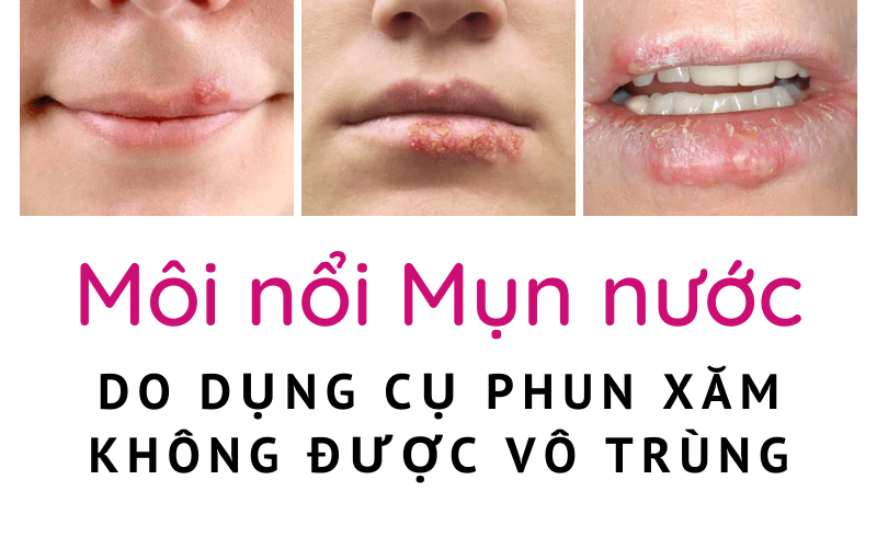 Mụn nước ở môi sau khi phun xăm có nguy hiểm không? Nên uống thuốc gì? môi nổi mụn nước do dụng cụ xăm không vô trùng