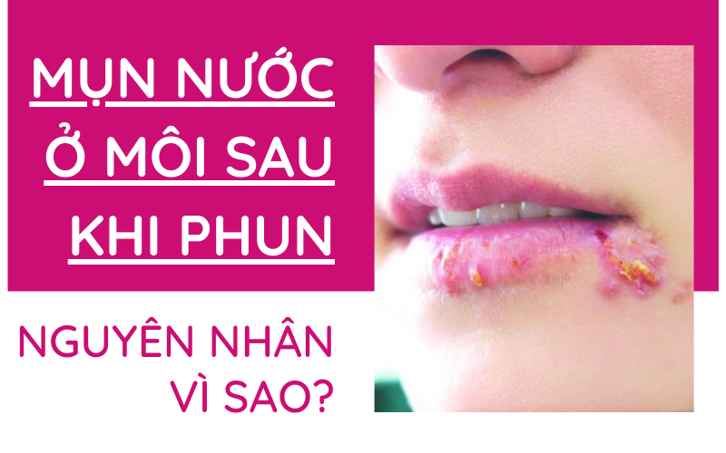 Mụn nước ở môi sau khi phun xăm có nguy hiểm không? Nên uống thuốc gì? môi sưng và có mụn nước sau phun