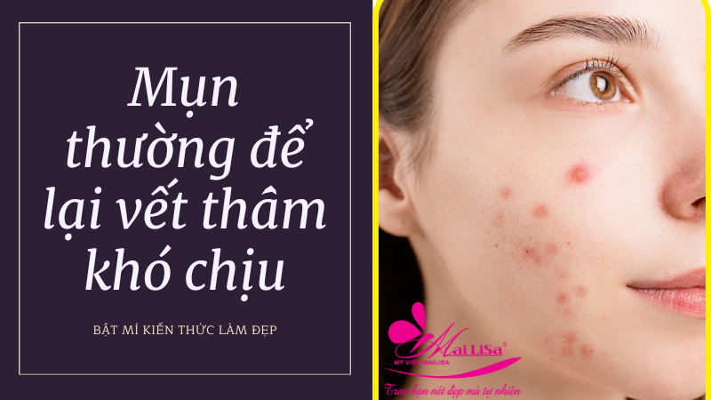 Bảng giá dịch vụ trị thâm mụn ở spa giá bao nhiêu 2022? hình ảnh mụn thường để lại vết thâm