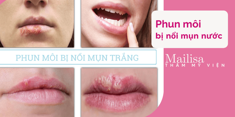 Phun môi bị hỏng, thất bại và nhiễm trùng thì phải làm sao? Cách khắc phục phun môi bị nổi mụn nước