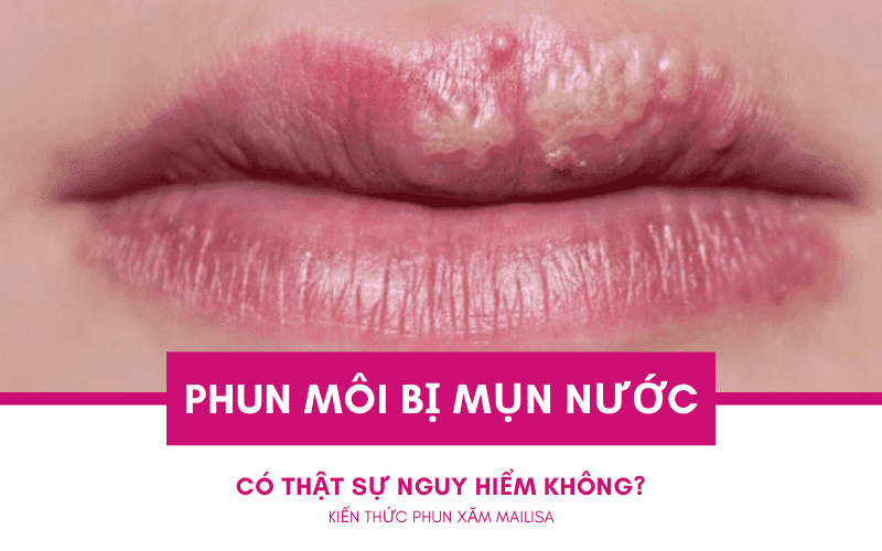 Mụn nước ở môi sau khi phun xăm có nguy hiểm không? Nên uống thuốc gì? xăm môi bị mụn nước có nguy hiểm không