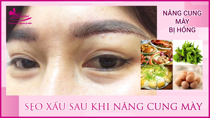 Biến chứng nghiêm trọng nâng cung mày bị hỏng 2023 Tác dụng của nâng cung chân mày