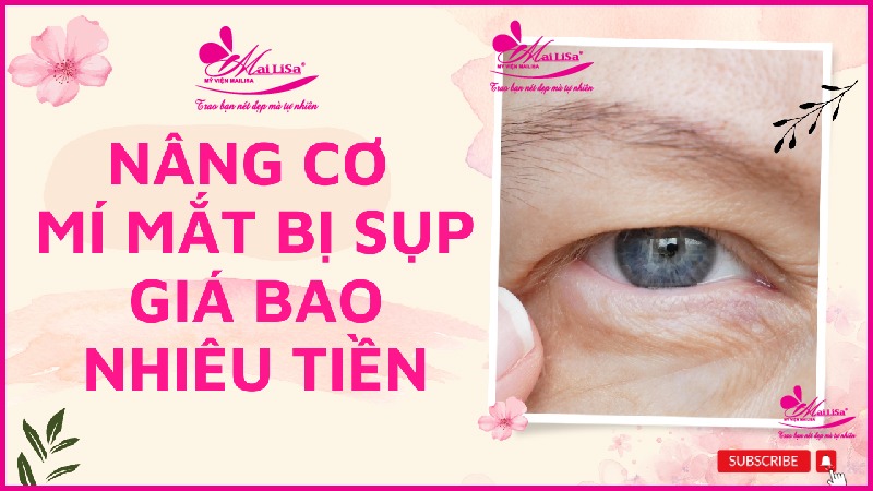 Phẫu thuật nâng cơ mí mắt là gì? Giá bao nhiêu HỢP LÝ 2023? Nâng cơ mí mắt bao nhiêu tiền