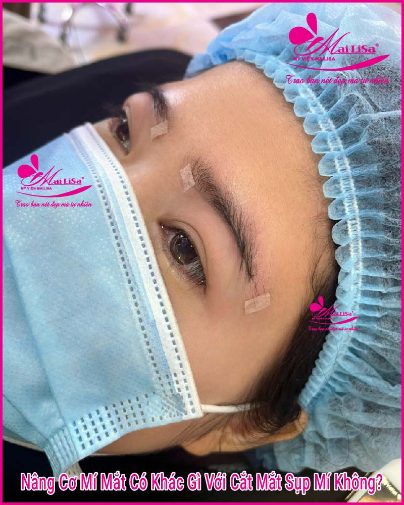 Phẫu thuật nâng cơ mí mắt là gì? Giá bao nhiêu HỢP LÝ 2023? Nânng cơ mí mắt có khác cắt sụp mí không
