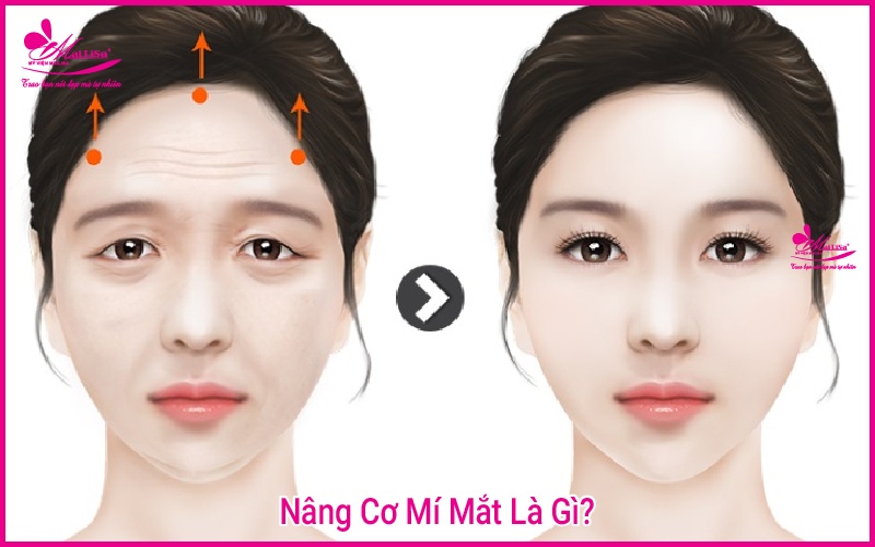 Phẫu thuật nâng cơ mí mắt là gì? Giá bao nhiêu HỢP LÝ 2023? Nâng cơ mí mắt là gì