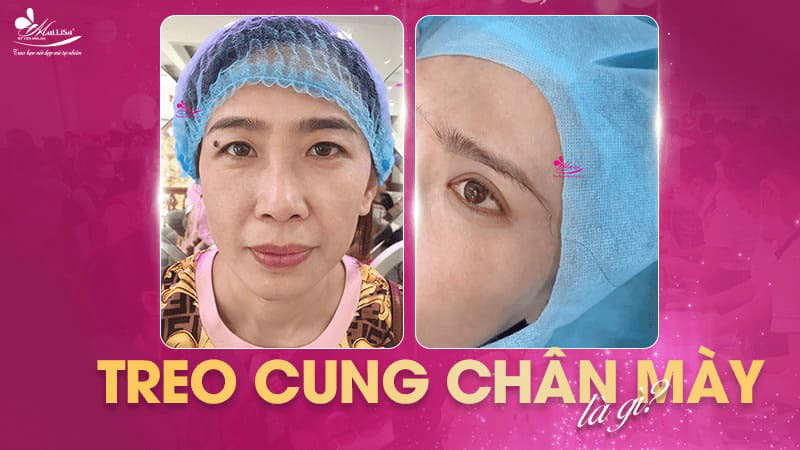 Treo chân mày là gì và có những phương pháp nào năm 2024 2 - 2 treo chân mày nang cung chan may la gi