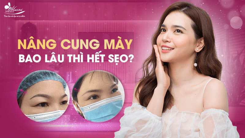 Treo chân mày là gì và có những phương pháp nào năm 2024 13 - 13 treo chân mày nang cung may bao lau thi het seo