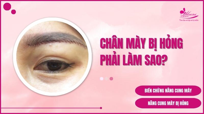 Biến chứng nghiêm trọng nâng cung mày bị hỏng 2023 nâng cung chân mày không phẫu thuật