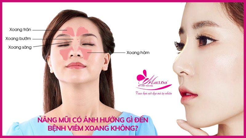 Bị viêm xoang có nâng mũi được không, có nguy hiểm không ? nâng mũi có ảnh hưởng gì không