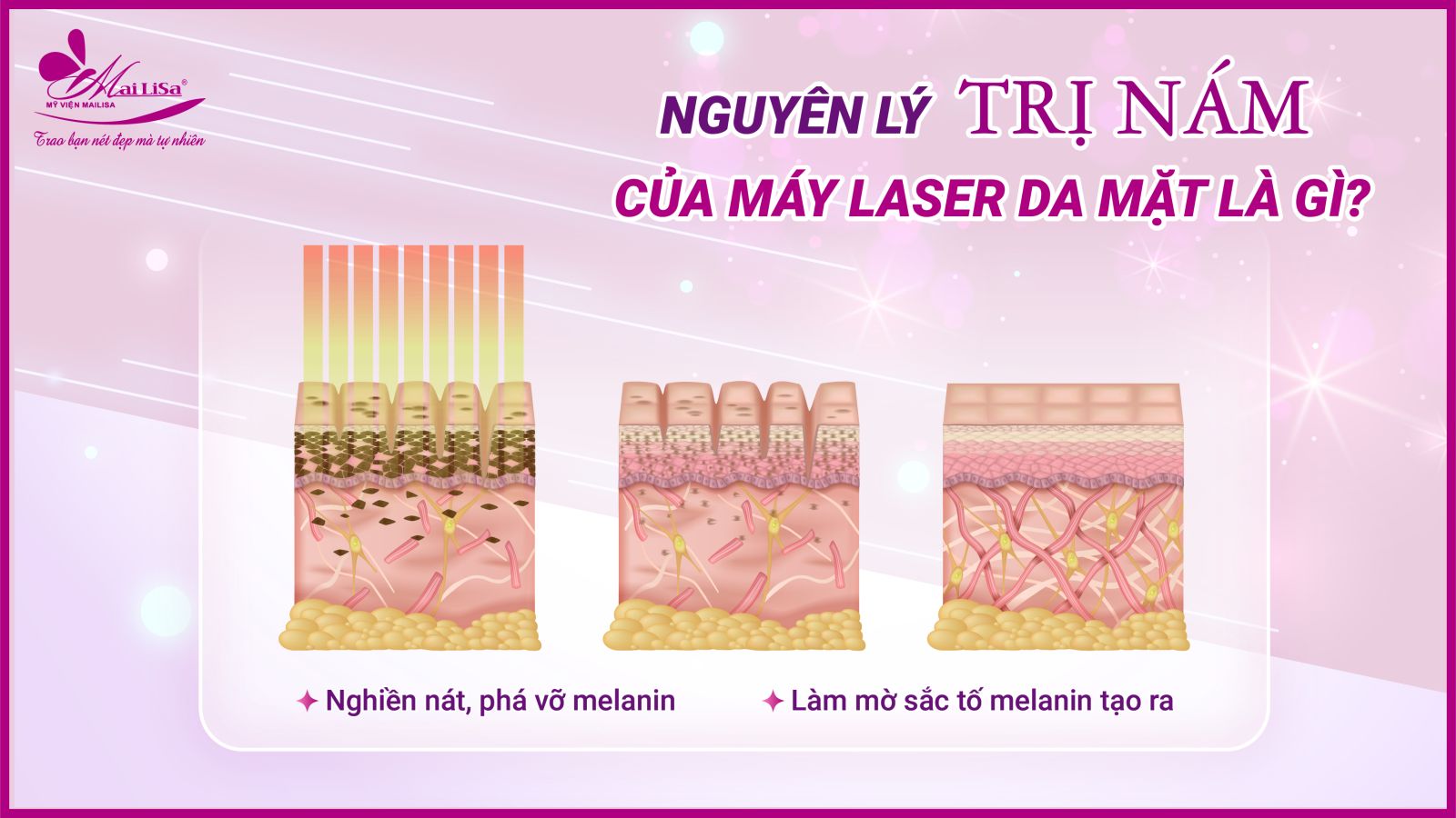 Bắn laser trị nám Whiteskin spectra có tốt không? Chi phí 2023 Bắn laser trị nám Whiteskin spectra có tốt không? Chi phí 2023