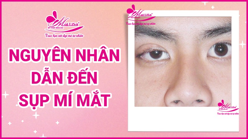 Phẫu thuật nâng cơ mí mắt là gì? Giá bao nhiêu HỢP LÝ 2023? Nguyên nhân dẫn đến sụp mí mắt