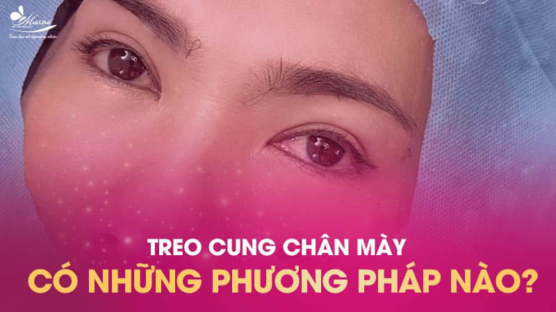 Treo chân mày là gì và có những phương pháp nào năm 2024 1 - 1 treo chân mày treo chân mày
