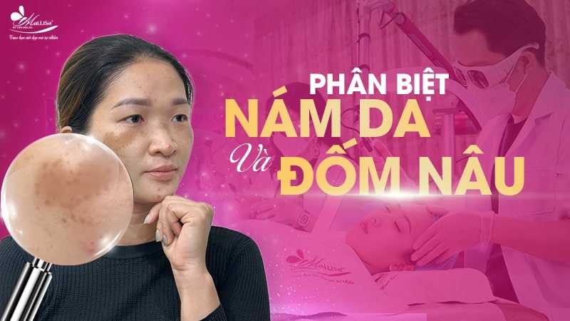 8 Cách trị đốm nâu trên mặt thịnh hành hiện nay 2 - 2 đốm nâu trên mặt Điều trị đốm nâu