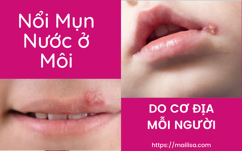 Mụn nước ở môi sau khi phun xăm có nguy hiểm không? Nên uống thuốc gì? môi nổi mụn nước sau phun do cơ địa