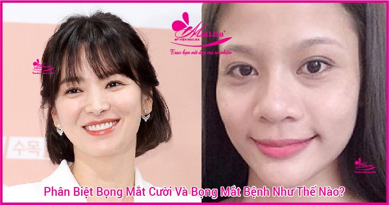 Người có bọng mắt to đẹp hay xấu? tướng số có tốt không? xem tướng qua mắt