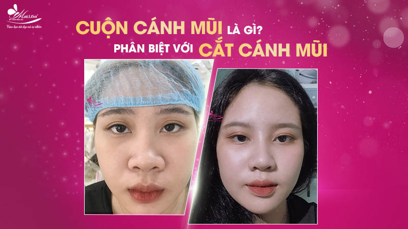 Cuốn cánh mũi bao nhiêu tiền? Bảng giá mới nhất 2024 3 - 3 cuốn cánh mũi bao nhiêu tiền phan biet phau thuat thu gon canh mui va cat canh mui