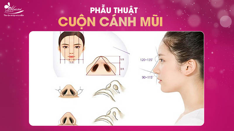 Cuốn cánh mũi bao nhiêu tiền? Bảng giá mới nhất 2024 6 - 6 cuốn cánh mũi bao nhiêu tiền phau thuat cuon canh mui