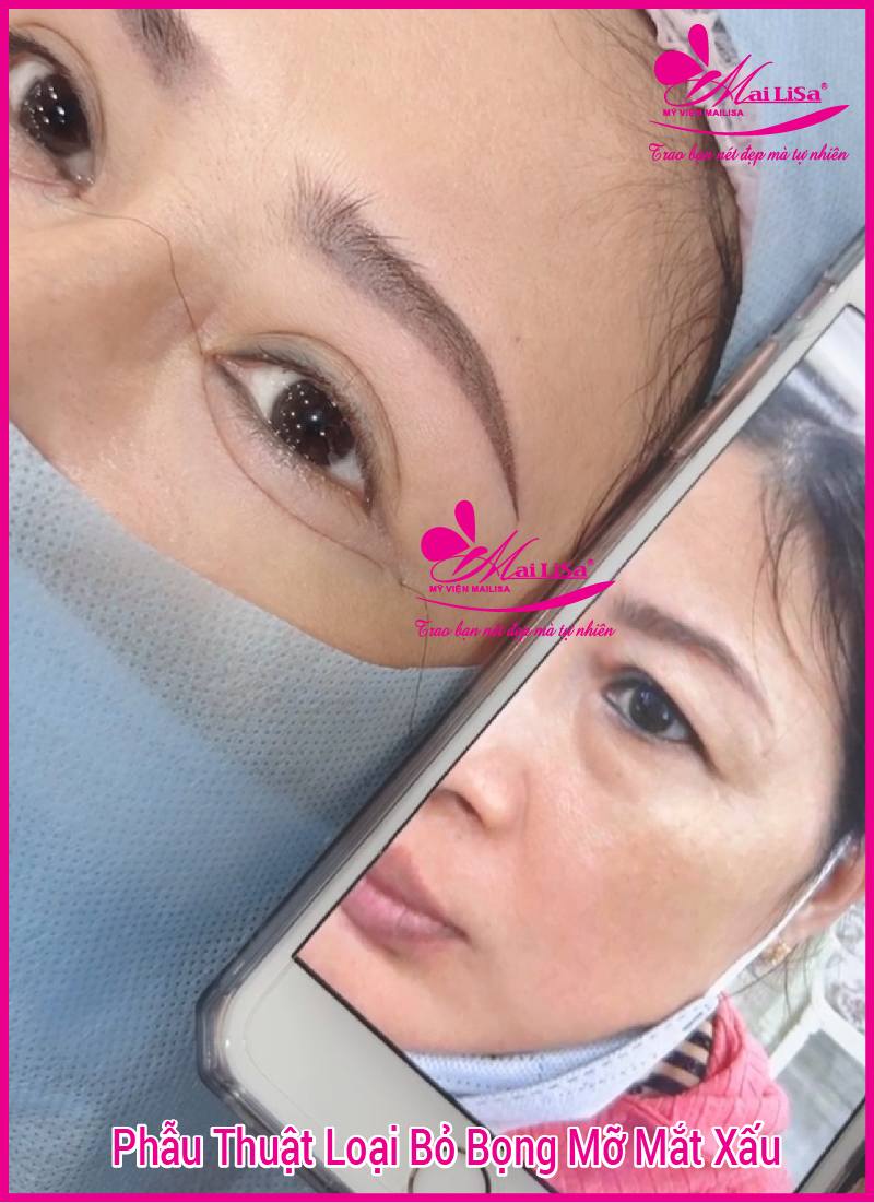 Người có bọng mắt to đẹp hay xấu? tướng số có tốt không? xem mắt đoán vận mệnh