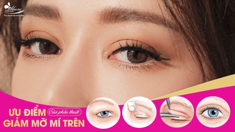 Lấy mỡ mí mắt trên bao nhiêu tiền? Dịch vụ ở đâu tốt 6 - 6 lấy mỡ mí mắt trên bao nhiêu tiền phau thuat mat loi bao nhieu tien