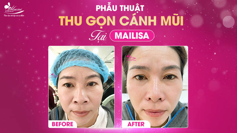 Cuốn cánh mũi bao nhiêu tiền? Bảng giá mới nhất 2024 11 - 11 cuốn cánh mũi bao nhiêu tiền phau thuat thu gon canh mui tai mailisa 2