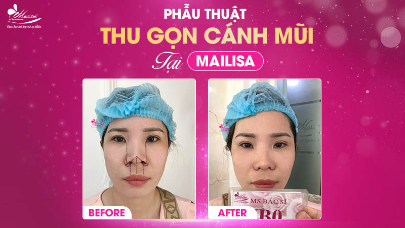 Cuốn cánh mũi bao nhiêu tiền? Bảng giá mới nhất 2024 12 - 12 cuốn cánh mũi bao nhiêu tiền phau thuat thu gon canh mui tai mailisa