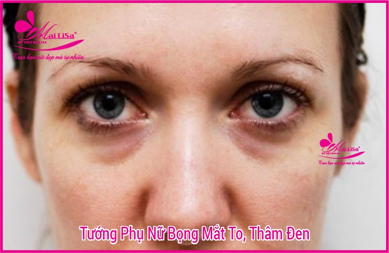 Người có bọng mắt to đẹp hay xấu? tướng số có tốt không? Phụ nữ có bọng mắt thâm đen