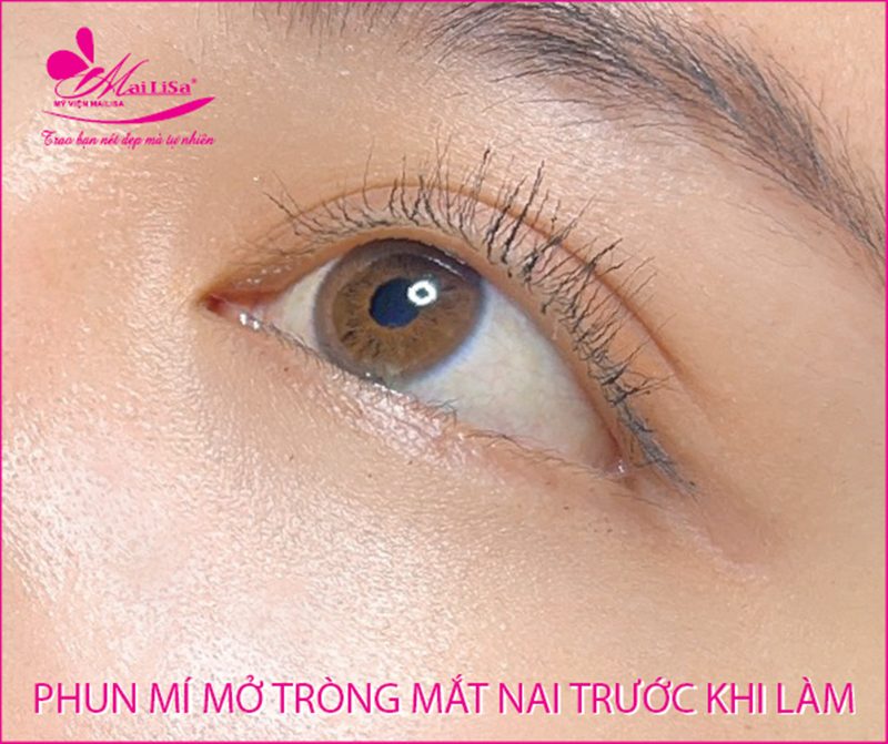 Phun mí mắt có đau không? Những lưu ý cần biết khi phun mí mắt hình ảnh phun mí mở tròng