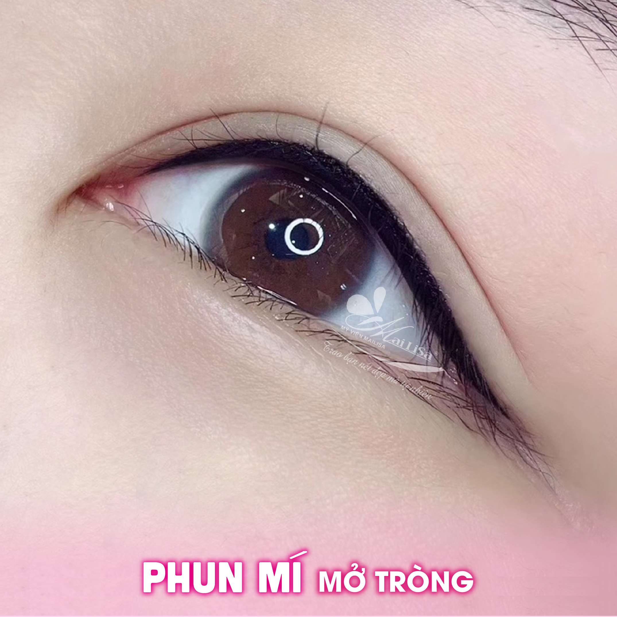 phun-mi-mo-trong-mat-nai-0-469-2 Phun mí mở tròng