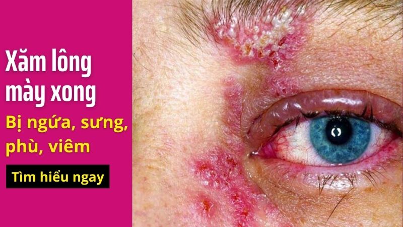 Phun xăm lông mày, môi có ảnh hưởng gì không? Có hại không? Có nguy hiểm không? Hình ảnh phun thêu xăm lông mày bị viêm nhiễm