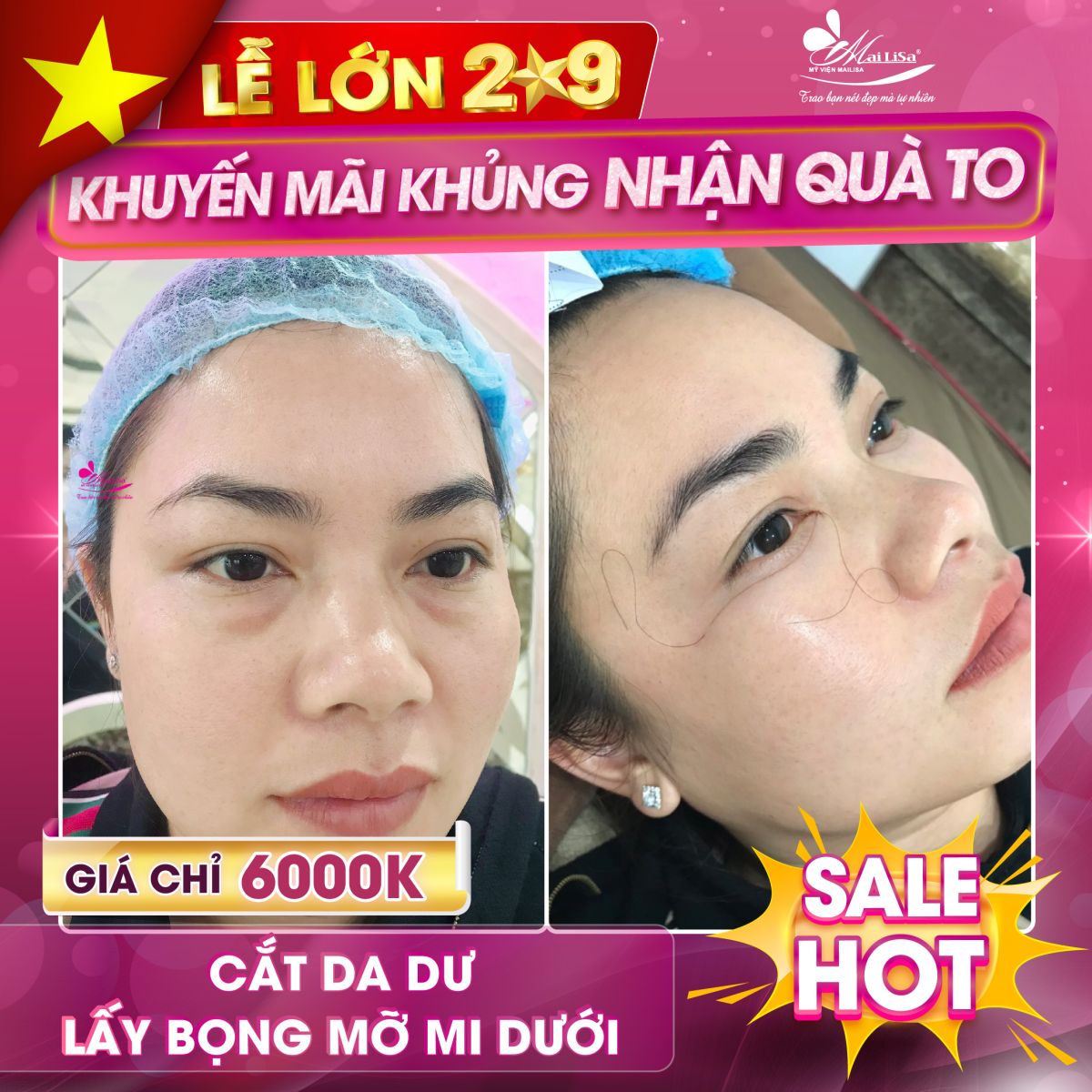 SĂN SALE KHỦNG lấy bọng mỡ mí mắt