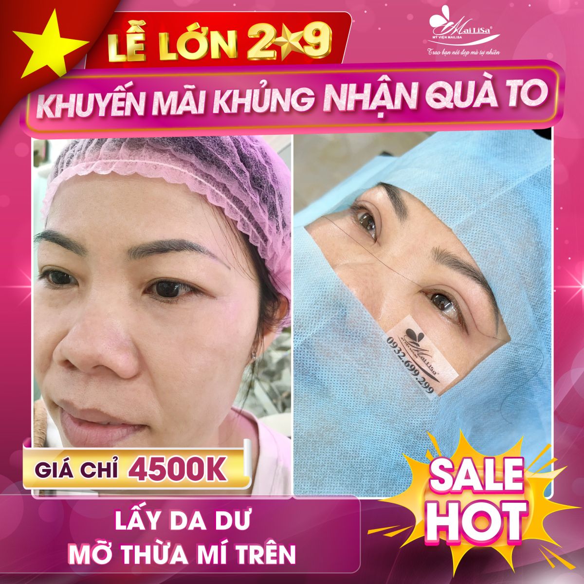 SĂN SALE KHỦNG da thừa mi trên