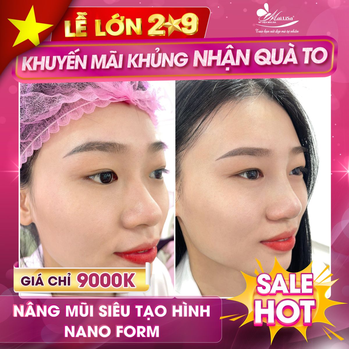SĂN SALE KHỦNG nâng mũi