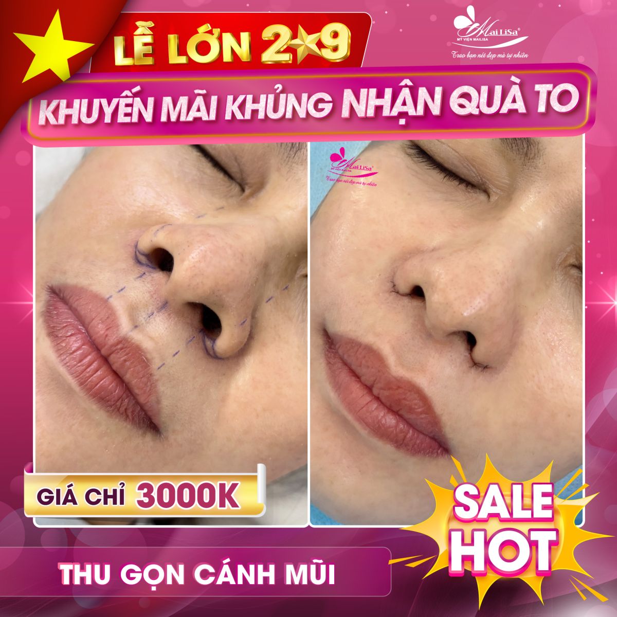 SĂN SALE KHỦNG thu gọn cánh mũi