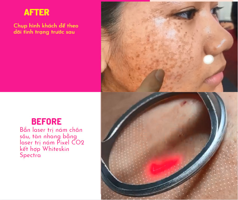 Bắn laser trị nám Whiteskin spectra có tốt không? Chi phí 2023 Bắn laser trị nám Whiteskin spectra có tốt không? Chi phí 2023