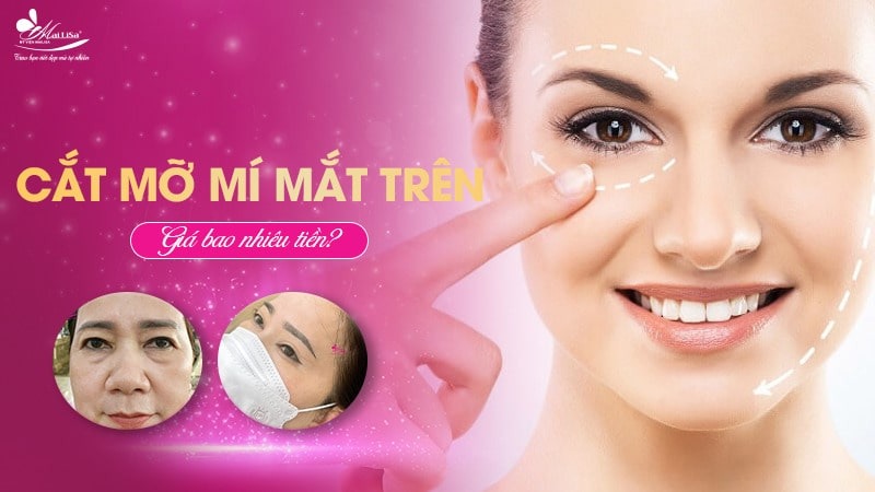 Lấy mỡ mí mắt trên bao nhiêu tiền? Dịch vụ ở đâu tốt 2 - 2 lấy mỡ mí mắt trên bao nhiêu tiền Lấy mỡ mí mắt trên bao nhiêu tiền