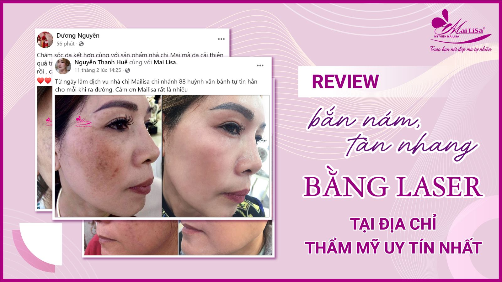 Bắn laser trị nám Whiteskin spectra có tốt không? Chi phí 2023 Bắn laser trị nám Whiteskin spectra có tốt không? Chi phí 2023