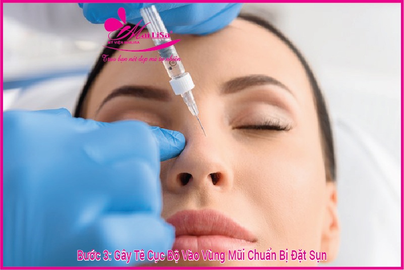 Bị viêm xoang có nâng mũi được không, có nguy hiểm không ? gây tê cục bộ