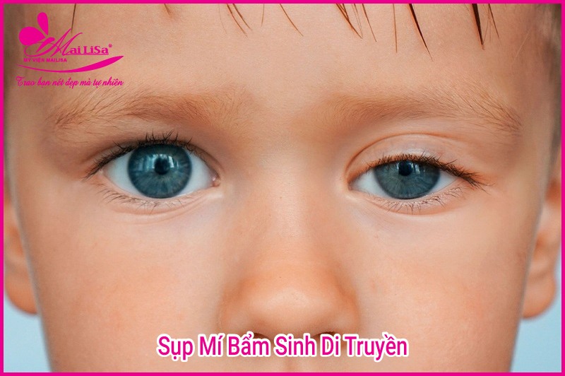 Phẫu thuật nâng cơ mí mắt là gì? Giá bao nhiêu HỢP LÝ 2023? Sụp mí bẩm sinh di truyền