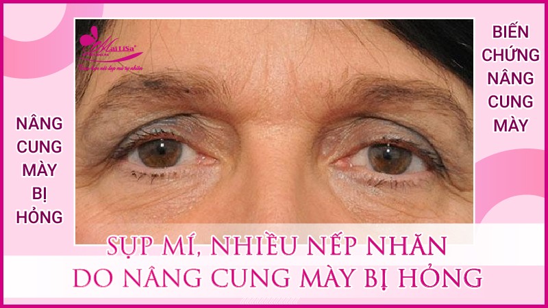 Biến chứng nghiêm trọng nâng cung mày bị hỏng 2023 Có mẹ nào nâng cung mày chưa