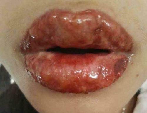 Giá phun xăm môi bao nhiêu tiền? Bảng giá phun môi CẬP NHẬT 2021 môi bị mưng mủ