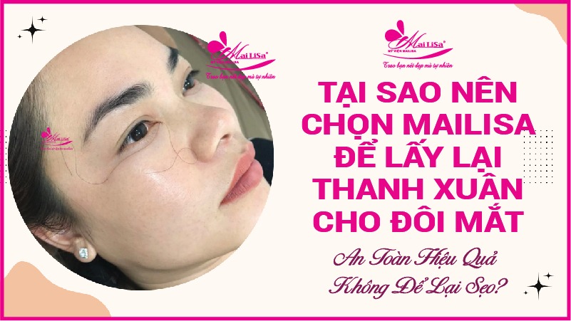 Người có bọng mắt to đẹp hay xấu? tướng số có tốt không? cắt bọng mỡ mắt