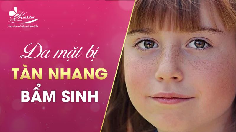 Tàn nhang bẩm sinh có chữa được không - 4 Cách chữa tàn nhang bẩm sinh 2 - 2 cách trị tàn nhang bẩm sinh tan nhang bam sinh