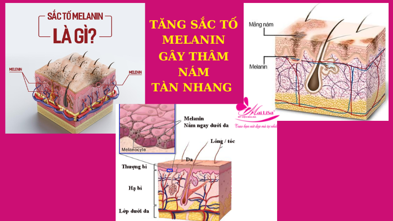 Bảng giá dịch vụ trị thâm mụn ở spa giá bao nhiêu 2022? thâm mụn do tăng sắc tố melanin