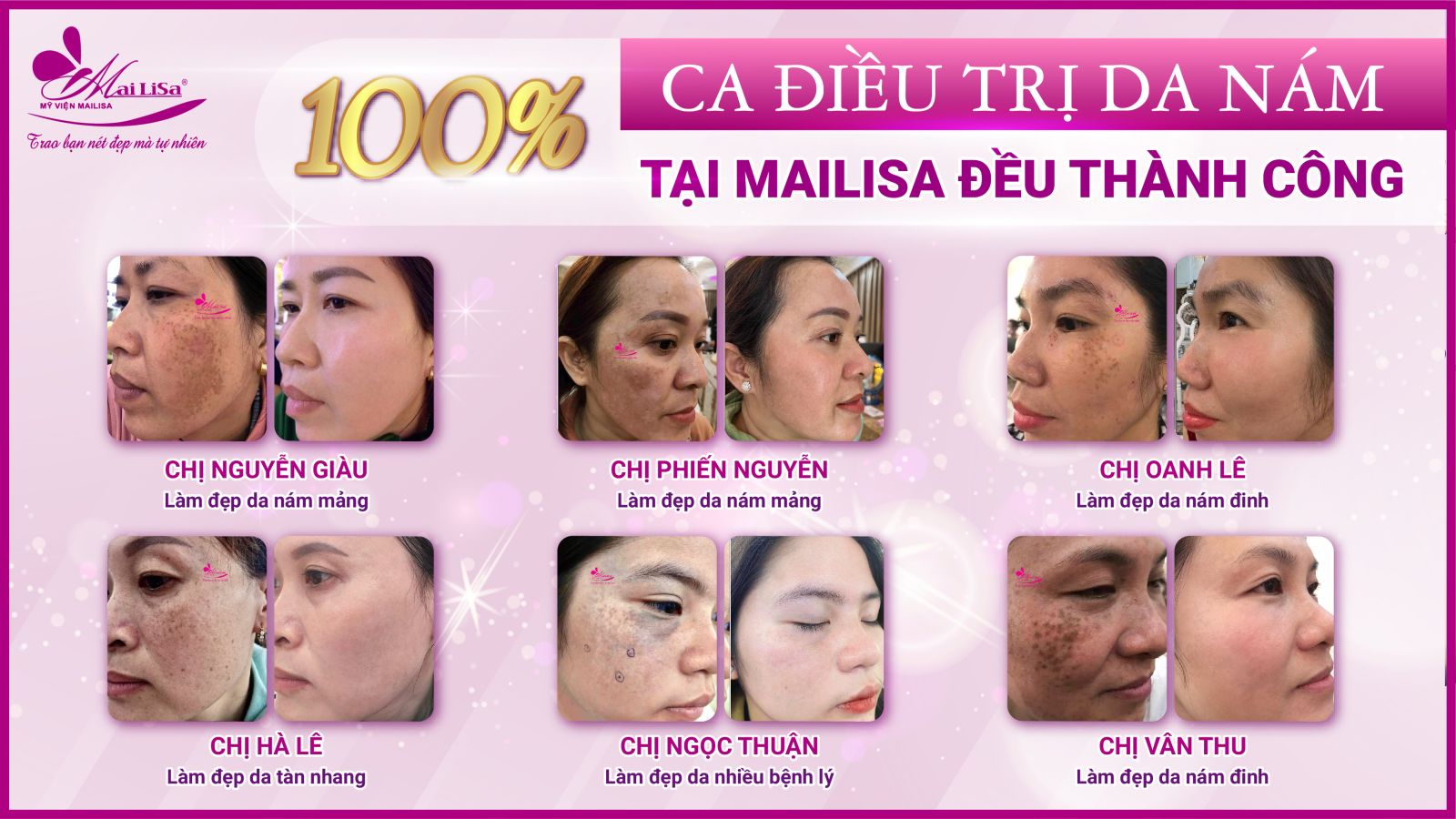 Bắn laser trị nám Whiteskin spectra có tốt không? Chi phí 2023 100% ca điều trị tại Mailisa đều thành công